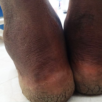 Ankylosing-Spondylitis